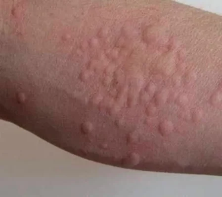 Chấm dứt nỗi ám ảnh bọ chét mèo: Bí quyết hiệu quả